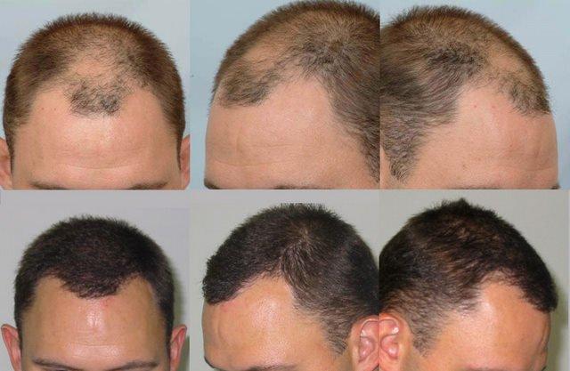 hårtransplantation resultater